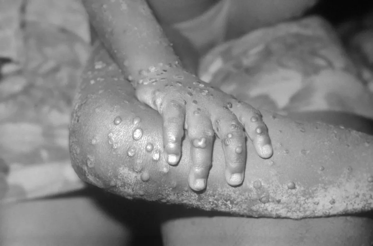 Сыпь при оспе обезьян у 4-летней девочки в Бондуа, графство Гранд-Геде, Либерия. Фото: phil.cdc.gov